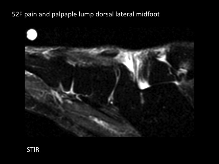 Figure 1 for case peroneus tertius ( RID2915 )